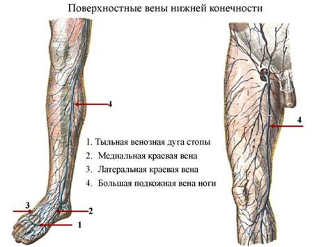 Несостоятельные перфорантные вены голени