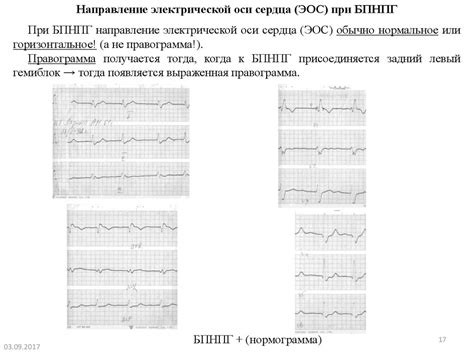 Неспецифическое нарушение внутрижелудочковой проводимости на ЭКГ: все, что нужно знать