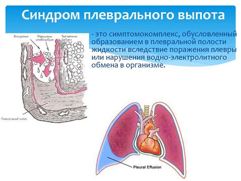 Обзор двустороннего выпота в плевре: основная информация