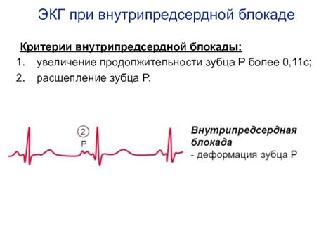 Обнаружение внутрипредсердной блокады 1 степени при ЭКГ и ее интерпретация