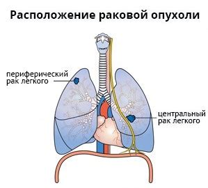 Общие методы лечения очага заболевания в правой доле легкого