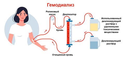 Определение гемодиализа и его назначение в медицине