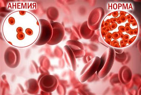 Осложнения при гемолитической анемии у взрослых: что стоит знать