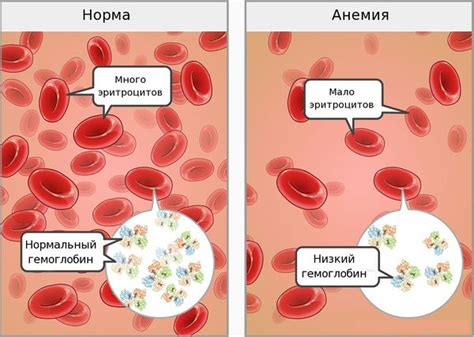 Основная причина повышенного содержания железа: железодефицитная анемия