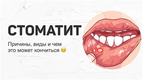 Основные виды стоматита и их проявления