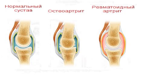 Основные признаки заболеваний суставов