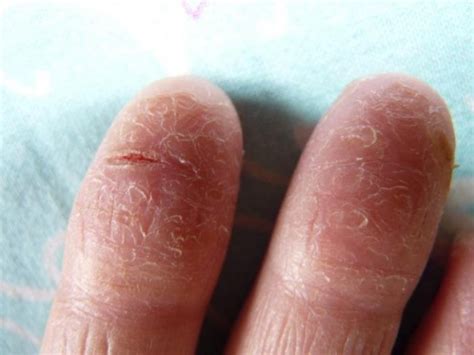 Основные признаки и симптомы шелушения на пальцах: как распознать проблему