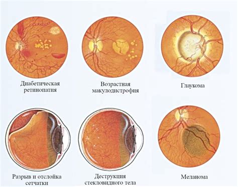 Основные признаки риска 4 степени атеросклероза глазного дна