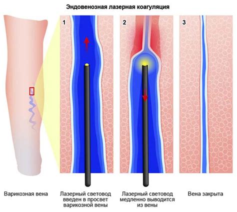 Основные принципы действия метода лазерной облитерации вен нижних конечностей