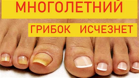 Основные принципы лечения утолщенных ногтей на ногах в домашних условиях