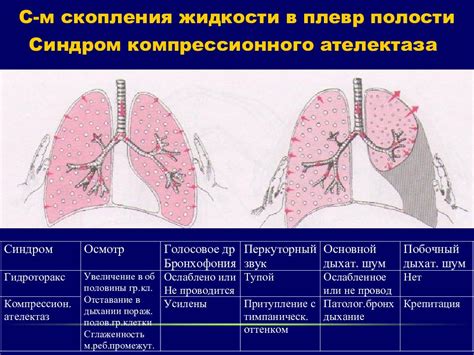 Основные факторы, способствующие развитию патологического скопления жидкости в обоих полостях грудиных плевр: