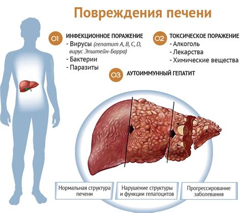 Основные факторы формирования образований в печени: причины и последствия