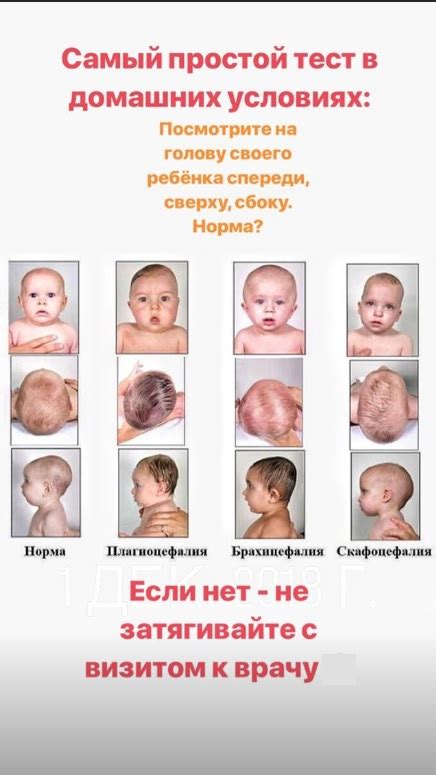 Особенности заботы о форме головы у малыша с деформацией черепа