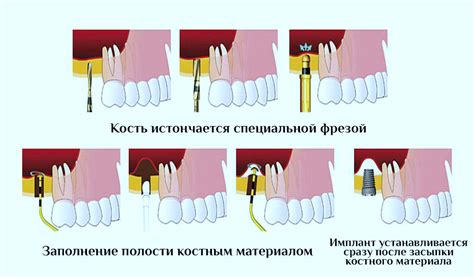 Особенности и применение различных подходов к синус лифтингу