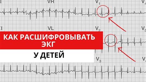 Особенности паттерна S на ЭКГ у юных пациентов