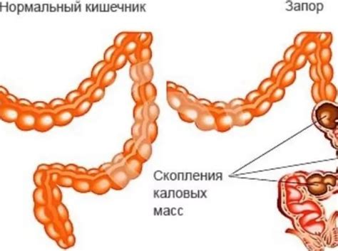 Отсутствие чувства нужды в опорожнении у взрослых: причины и пути решения