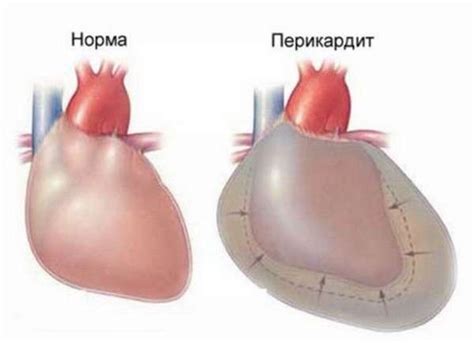 Патологическое скопление жидкости в перикарде: причины и методы лечения