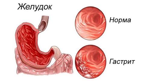 Первичные причины болей в желудке