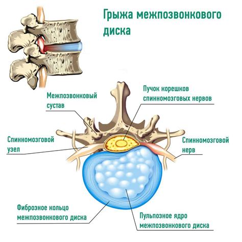 Повреждение межпозвонковых дисков