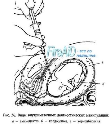 Повышенная активность плода