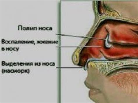 Полипы в носовых пазухах