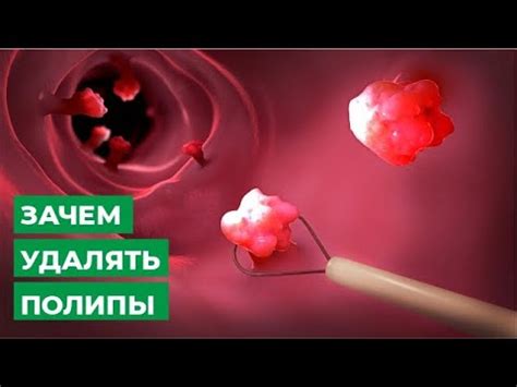 Полипы и новообразования