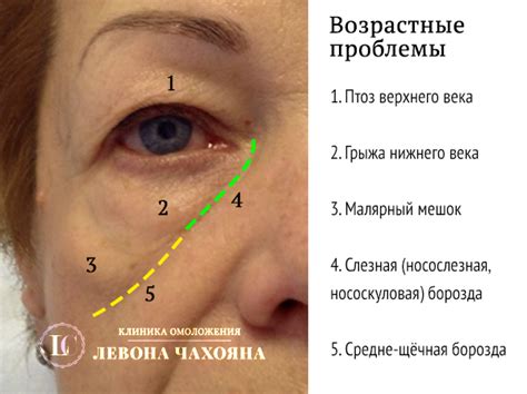 Популярные народные рецепты для устранения жирового образования над глазами