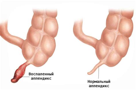 Почему возникает гнойный процесс в пупке после прокола?