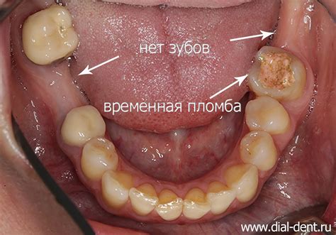 Почему отсутствуют два зуба жевательных?