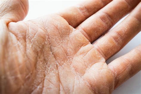 Превентивные меры для борьбы с отшелушиванием кожи на пальцах