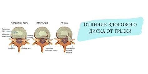 Предупреждение грыжи: основные рекомендации