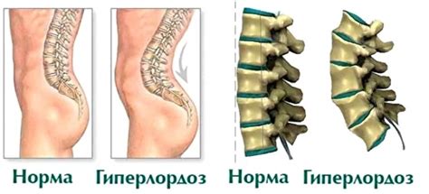 Преодоление гиперлордоза поясницы у маленького пациента без применения медикаментов