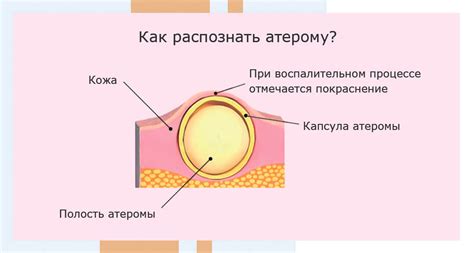 Применение массажа для исключения атеромы: подходы и преимущества