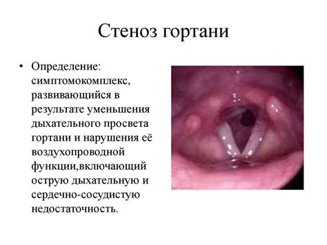 Применение при различных заболеваниях гортани