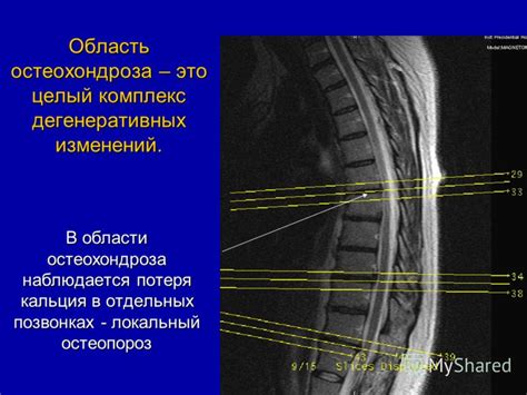 Принципы действия инъекций в лечении дегенеративных изменений в области шейного отдела позвоночника