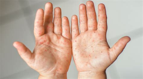 Причины возникновения многочисленных высыпаний на коже