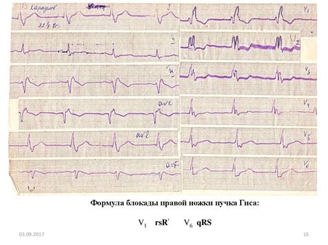 Причины возникновения неспецифической внутрижелудочковой блокады