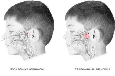 Причины возникновения увеличенных аденоидов у детей