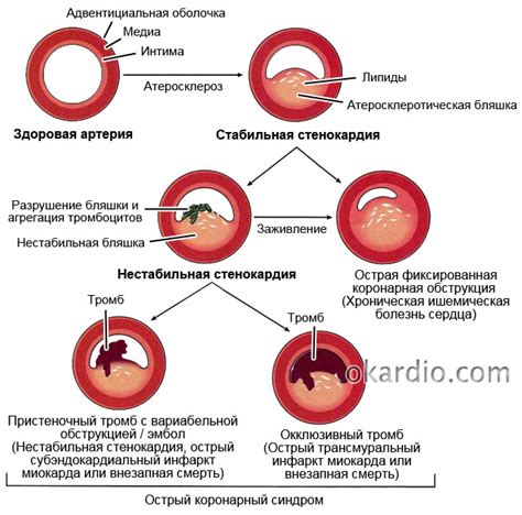 Причины и симптомы нестабильной прогрессирующей стенокардии