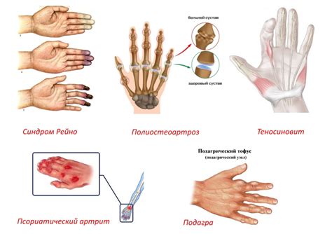 Причины и симптомы отечности пальцев на нижних конечностях