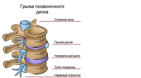 Причины и факторы развития ограничения подвижности в шейном позвоночнике