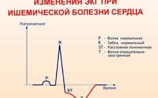 Причины нарушений реполяризации