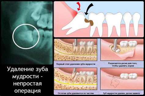 Причины неудачного удаления зуба мудрости