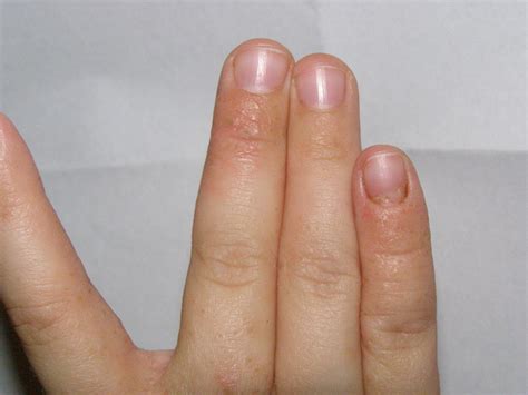 Причины появления отшелушивания на пальцах и его возможные смыслы