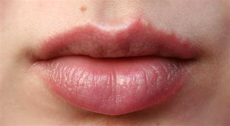 Причины проявления неприятных состояний на губах