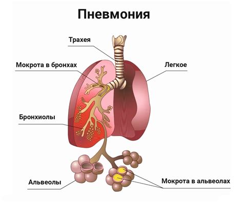 Причины снижения аппетита при пневмонии