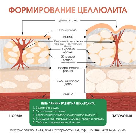 Происхождение и причины образования целлюлита