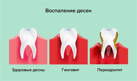 Профилактика и лечение воспаления десен