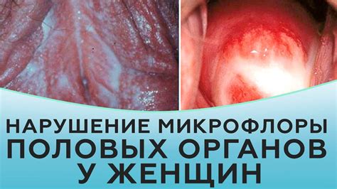 Профилактика нарушения микрофлоры в женских половых органах: советы и рекомендации