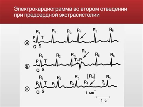 Распространенность парной предсердной экстрасистолии и группы риска